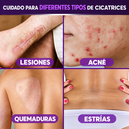 Gel Para Cicatrices y Estrías - Belleza y cuidado para una piel radiante